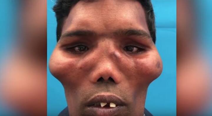 सर्जरी के बाद से ही सुरेश की तस्वी सोशल मीडिया पर वायरल हो रही हैं. डॉक्टर्स के मुताबिक, मेडिकल साइंस में सुरेश की बीमारी को फाइब्रस डिस्प्लेसिया के नाम से जाना जाता है. फोटो: यूट्यूब