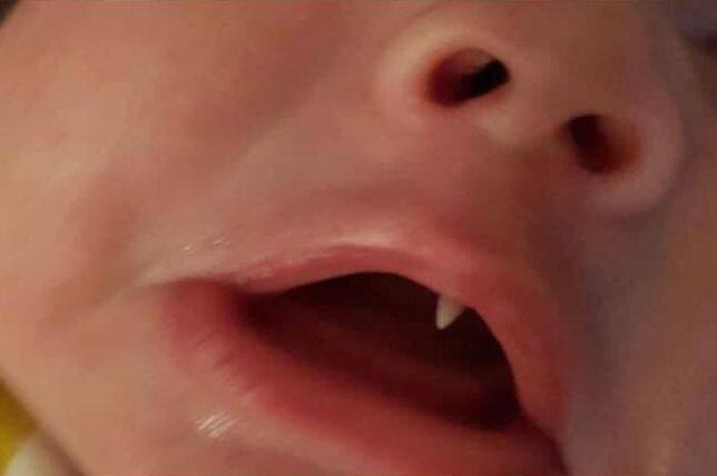 हालांकि उसी दिन ऑस्कर दिनभर रोता रहा तब जाकर तारा ने ऑस्कर को डॉक्टर को दिखाया तो पाया कि बच्चे को ऐसा दांत निकल आया है. फोटोः फेसबुक