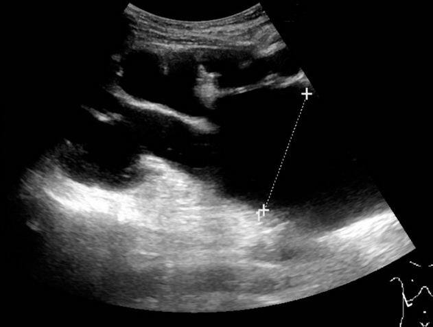ऑपरेशन से पहले डॉक्टर्स ने इस महिला की दो एमआरआई रिपोर्ट तक चैक नहीं की जिसमें साफ जाहिर था कि महिला की पेल्विक किडनी है वो भी हेल्दी.   फोटोः गूगल फ्री इमेज 