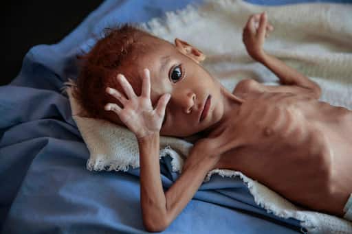 Yemen war: 85000 kids die because of malnutrition यमन युद्ध: कुपोषण से 85,000 बच्चों की मौत, परिजनों ने बच्चों को मरते हुए देखा