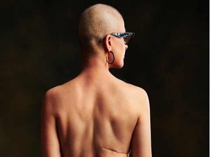 World Cancer Day: Ayushmann Khurrana’s wife Tahira Kashyap bares her scars in powerful pic कैंसर से जूझ रही आयुष्मान खुराना की पत्नी ने शेयर की तस्वीर, कहा- ये मेरा दिन है