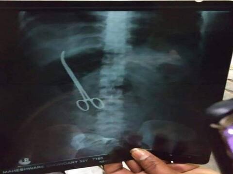 लापरवाही: डॉक्टरों ने सर्जरी के दौरान महिला के पेट में कथित तौर पर छोड़ी कैंची, मामला दर्ज लापरवाही: डॉक्टरों ने सर्जरी के दौरान महिला के पेट में कथित तौर पर छोड़ी कैंची, मामला दर्ज