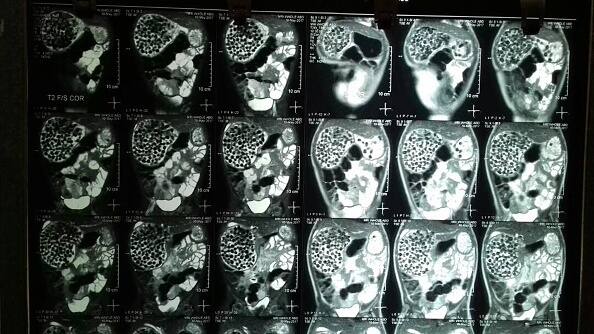 इस ऑपरेशन के तहत जियांग की एंडोस्कॉपी और गैस्ट्रोकॉपी भी हुई.