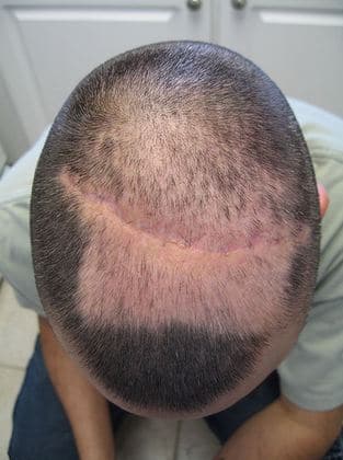 શું હેલ્મેટ પહેરવાથી ટાલ પડે છે ? જાણો હકીકત