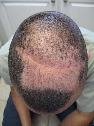 आज के लाइफस्टाइल के चलते गंजापन होना आमबात है. लेकिन क्या आप जानते हैं गंजेपन के लक्षण पहले ही दिखने लगते हैं. ये हम नहीं कह रहे बल्कि कुछ समय पहले आई रिसर्च में ये दावा किया गया है. चलिए जानते हैं वे कौन से लक्षण हैं जो गंजेपन की तरफ इशारा करते हैं. फोटोः गूगल फ्री इमेज