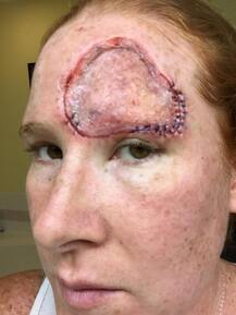 OMG! टैनिंग की वजह से एक महिला को हुआ स्किन कैंसर, जानें क्या है पूरा मामला