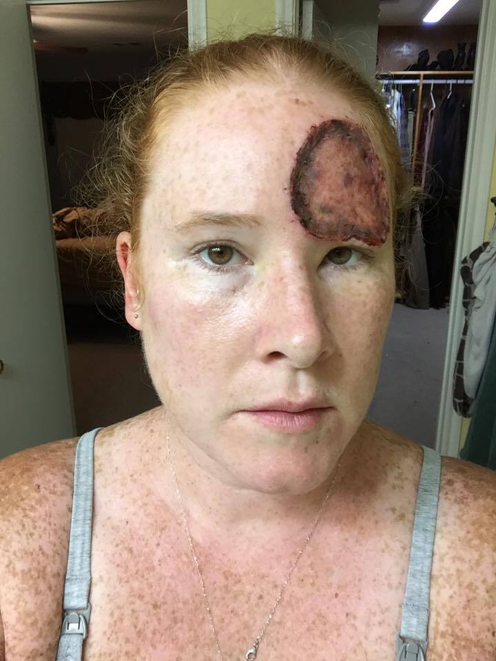 एक रिसर्च के मुताबिक, अधिक देर धूप में रहने से भी स्किन कैंसर का खतरा बढ़ जाता है. 