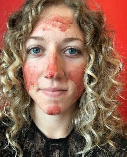 दरअसल, निक्स को बहुत ज्यादा ब्लीडिंग होती थी. तो उन्होंने एक्सपेरिमेंट के तौर पर ऐसा किया.   