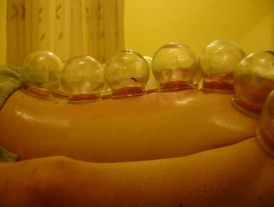 कपिंग थेरेपी को कप ये किया जाता है. इसमें सक्शन के दबाव की मदद से स्किन, टिशू और मांसपेशियों को ऊपर खींचा जाता है.फोटोः गूगल फ्री इमेज