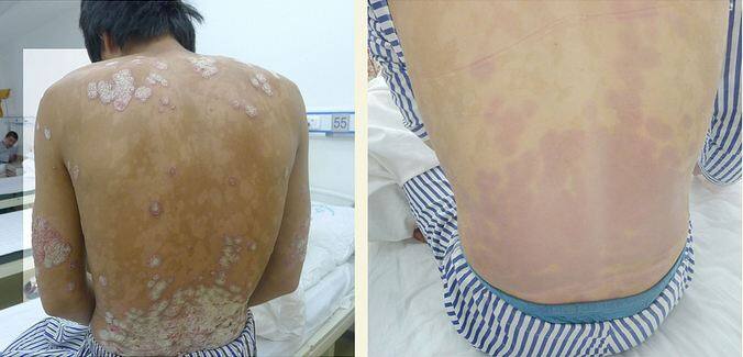 Smoking increases double the risk of psoriasis expert says धूम्रपान से दोगुना बढ़ जाता है सोराइसिस का खतरा : एक्सपर्ट