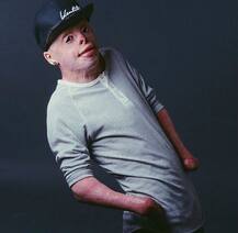 हैरतअंगेज! 4 साल की उम्र में 95 फीसदी जल गया था जॉनी, अब करता है मॉडलिंग