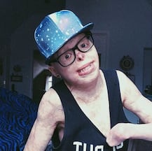 हैरतअंगेज! 4 साल की उम्र में 95 फीसदी जल गया था जॉनी, अब करता है मॉडलिंग