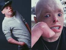 हैरतअंगेज! 4 साल की उम्र में 95 फीसदी जल गया था जॉनी, अब करता है मॉडलिंग