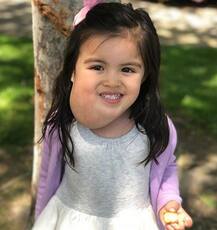 OMG! फेशियल ट्यूमर के साथ ही पैदा हुई थी ये बच्ची, जानें क्या है पूरा मामला