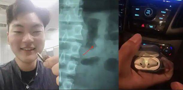 सोने के दौरान इस व्यक्ति ने गलती से निगल लिया एपल AirPod, पेट के अंदर भी काम करता रहा एपल का ये प्रोडक्ट