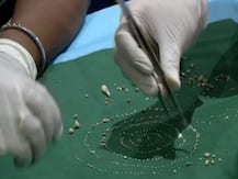 अजीबोगरीब: चेन्नई में 7 साल के बच्चे के मुंह से डॉक्टरों ने निकाले 526 दांत, जानिए क्या है पूरा मामला