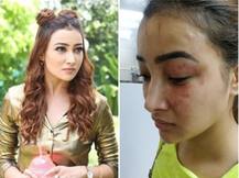 टीवी अभिनेत्री नलिनी नेगी को मां के साथ मिल कर रूममेट ने पीटा, चेहरे का हुआ बुरा हाल