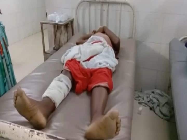 Bihar Gaya to treat hydrocele doctors operate upon man leg बिहार में अजीबोगरीब मामला, हाइड्रोसील की जगह डॉक्टरों ने कर दिया पैर का ऑपरेशन