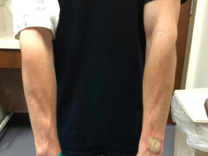 fitbit burning wrist