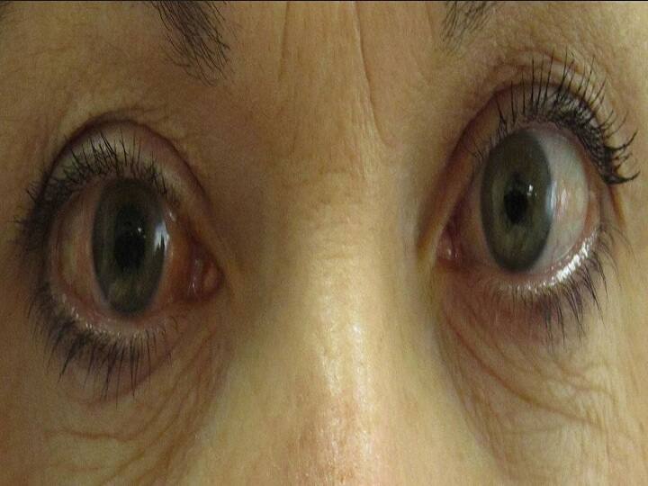 सावधान, वायु प्रदूषण से हो सकती है आंखों की ये दुर्लभ बीमारी Air pollution linked to higher risk of glaucoma सावधान, वायु प्रदूषण से हो सकती है आंखों की ये दुर्लभ बीमारी