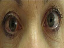 सावधान, वायु प्रदूषण से हो सकती है आंखों की ये दुर्लभ बीमारी