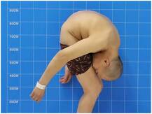 18 साल तक घुटनों से सटा रहा चेहरा, 28 साल बाद सीधा खड़ा हुआ मरीज