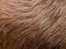 Health Tips: डैंड्रफ से छुटकारा दिलाने में इन 5 होममेड पेस्ट का कोई मुकाबला नहीं