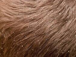 जिद्दी डैंड्रफ को कहें बाय-बाय, रूसी दूर भगाने के लिए अपनाएं ये घरेलू उपाय