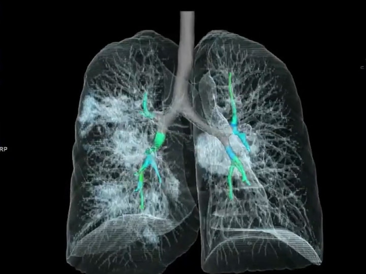 first 3D picture of lung of coronavirus patient सामने आई कोरोना के मरीज के फेफड़े की पहली 3D तस्वीर, हवा की जगह कुछ और ही दिखा!