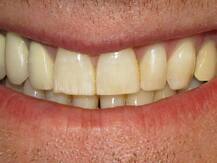 Health Tips: दांतों के पीलेपन से हैं परेशान, तो आजमाएं ये असरदार घरेलू उपाय