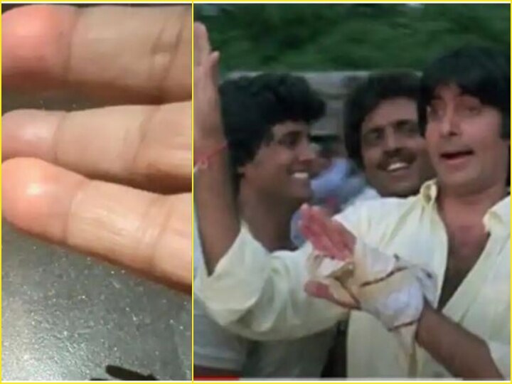 How the bomb exploded in the hand on Diwali, remembering the scene, Big B shared a picture किस तरह दिवाली पर हाथ में फटा था बम, मंजर याद कर बिग बी ने शेयर की तस्वीर