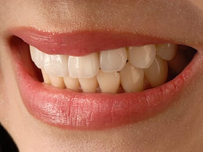 Health Tips How To Clean Your Teeth After Eating Spinach | मुंह और मंसूड़ों  के कई रोगों का कारण बनता है आपके दांतों में जमा प्लाक, इन 5 तरीकों से करें  साफ