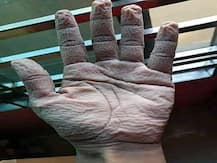 साहस को सलाम: 10 घंटे ड्यूटी करने के बाद डॉक्टर ने निकाले दस्ताने, हाथों में दिखी झूर्रियां