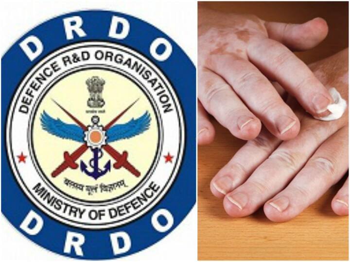 These herbs will stop white stains DRDO prepared the medicine सफेद दाग को रोकेगी ये बूटी, डीआरडीओ ने तैयार की दवा
