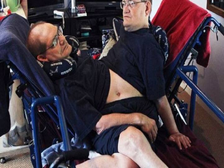 अमेरिका: दुनिया के सबसे अधिक उम्र के शरीर से जुड़े जुड़वा भाइयों का निधन In America twins died who were attached through body at the age of 68 अमेरिका: दुनिया के सबसे अधिक उम्र के शरीर से जुड़े जुड़वा भाइयों का निधन