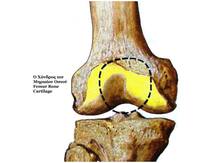 'कृत्रिम करकरी हड्डी' सर्जरी में ला सकती है बड़ा परिवर्तन, शुरुआती ट्रायल से वैज्ञानिकों को उम्मीद