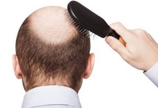 Study claims men who have completely lost their hair are 40% more likely to end up in hospital with corona virus ब्रिटेन में बालों के हवाले से कोविड-19 पर किया गया शोध, गंजे पुरुषों के लिए चौंकानेवाली खबर