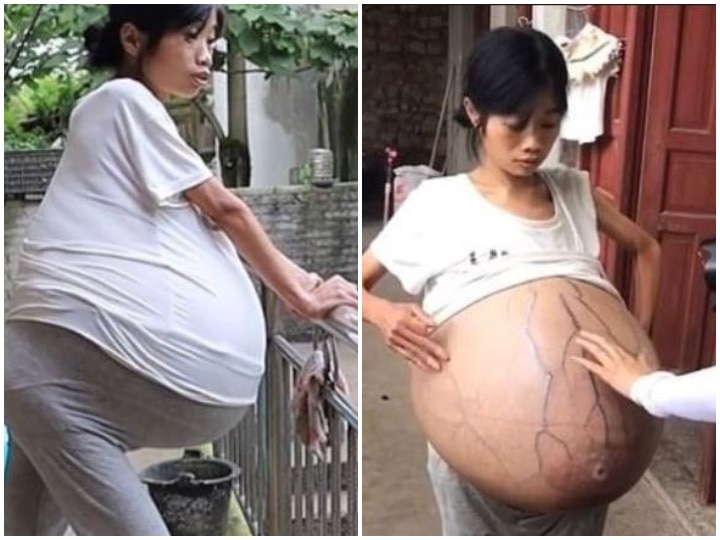 A woman's stomach mysteriously increased to 19 kg in China बीमारी के कारण चीन की महिला का पेट अनियंत्रित तरीके से फूला, 19 किलो है पेट का वजन