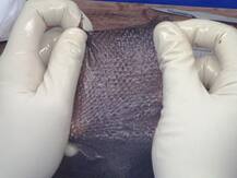 स्किन डोनेट कर दुर्घटनाग्रस्त, जले हुए मरीजों की दी जा सकती है नई ज़िंदगी, जानिए क्या है प्रक्रिया