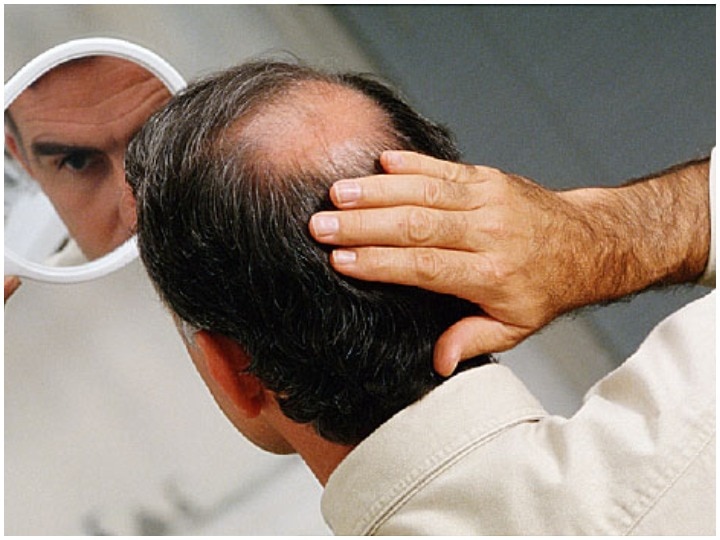 Hair fall may lead to baldness, know how to make hair strong and tips