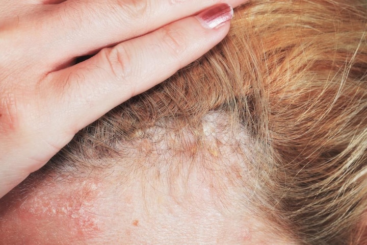 Stress may cause scalp inflammation, hair loss and swelling, know the effective solutions. तनाव के कारण झड़ रहे हैं आपके खूबसूरत बाल और आ रही है स्कैल्प पर सूजन, तो अपनाएं ये असरदार उपाय