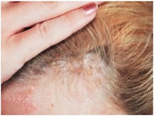 सर्दी में बालों के झड़ने की समस्या है सभी उम्र के लोगों की चिंता का कारण, ऐसे दूर करें शिकायत