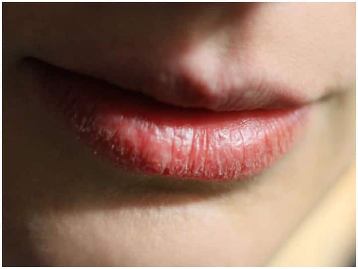 Winter Lip Care: इन प्रभावी देसी टोटकों से सर्दी के मौसम में फटे और रूखे होठों का करें खात्मा Winter Lip Care: Try these effective home remedies for dry and chapped lips in winter Winter Lip Care: इन प्रभावी देसी टोटकों से सर्दी के मौसम में फटे और रूखे होठों का करें खात्मा