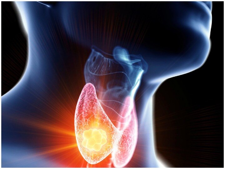 Why it is necessary to understand common myths about Thyroid disease? क्या थाइरॉयड के मरीज का वजन कभी नहीं घटता? जानें बीमारी से जुड़ी अफवाहें और उनका सच