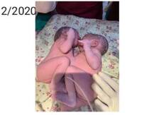 मुंबई: डॉक्टरों की टीम का कमाल, जन्म से आपस में जुड़ी बच्चियों को सर्जरी के बाद किया अलग