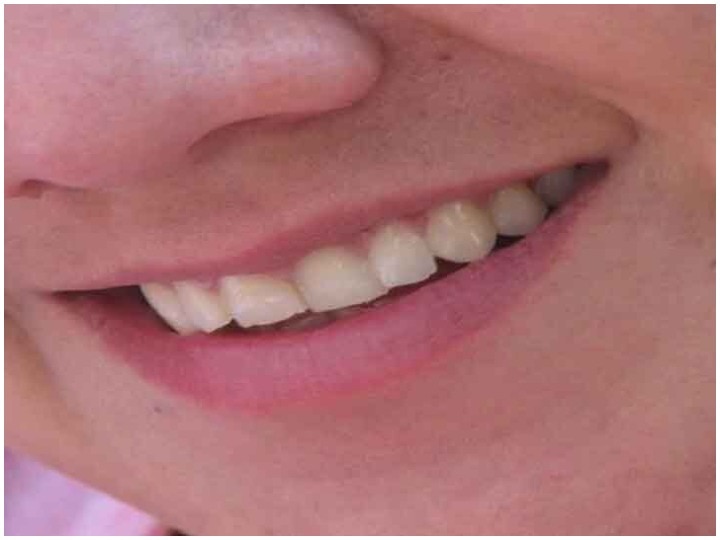 Health tips: May bleeding gums be a sign for vitamin C deficiency, Know here Health tips: जानिए मसूड़ों से खून का बहना कहीं विटामिन C की कमी का नतीजा तो नहीं है?