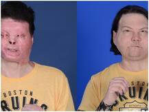 अमेरिका: मेडिकल वर्ल्ड में नया करिश्मा, ट्रांस्पलांट ने बदल दी 22 साल के युवक की जिंदगी