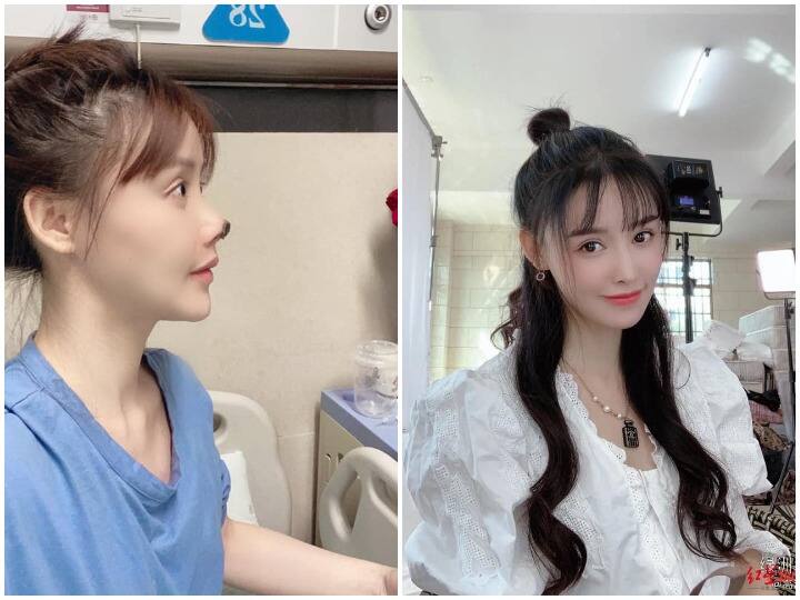 Chinese actress Gao Liu had to undergo cosmetic surgery heavily चीन की अभिनेत्री Gao Liu को कॉस्मेटिक सर्जरी कराना पड़ा भारी, 61 हजार डॉलर का नुकसान हुआ