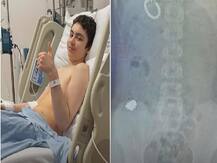 12 साल के लड़के ने निगली 54 मैग्नेटिक बॉल्स, जानना चाहता था कि क्या शरीर के अंदर जाकर चिपकेंगी