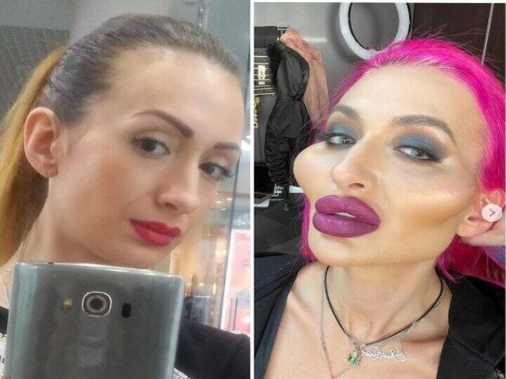 Shocking: सुंदर दिखने की चाह पड़ी भारी, गालों की सर्जरी करवाने वाली मॉडल का चेहरा दिखने लगा ऐसा Shocking: Have you ever seen such big cheeks? If not then see now Shocking: सुंदर दिखने की चाह पड़ी भारी, गालों की सर्जरी करवाने वाली मॉडल का चेहरा दिखने लगा ऐसा